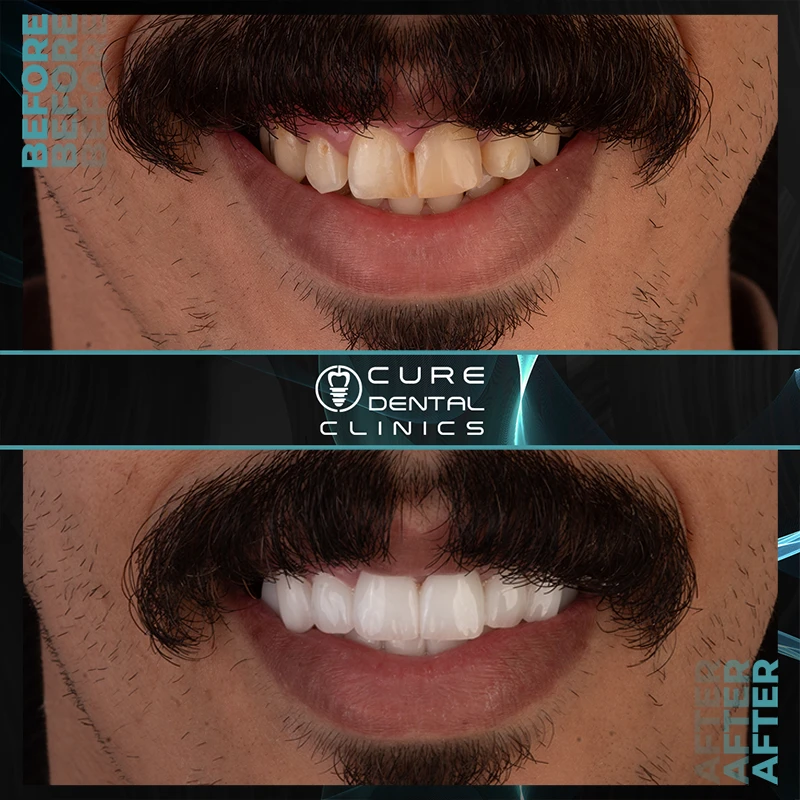 الفينير للأسنان