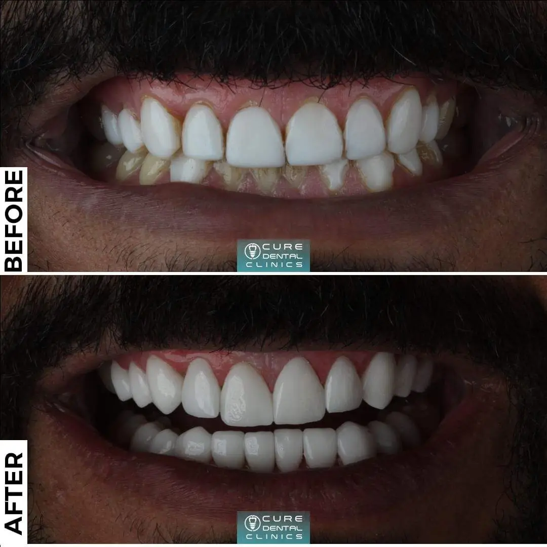 فينير الأسنان