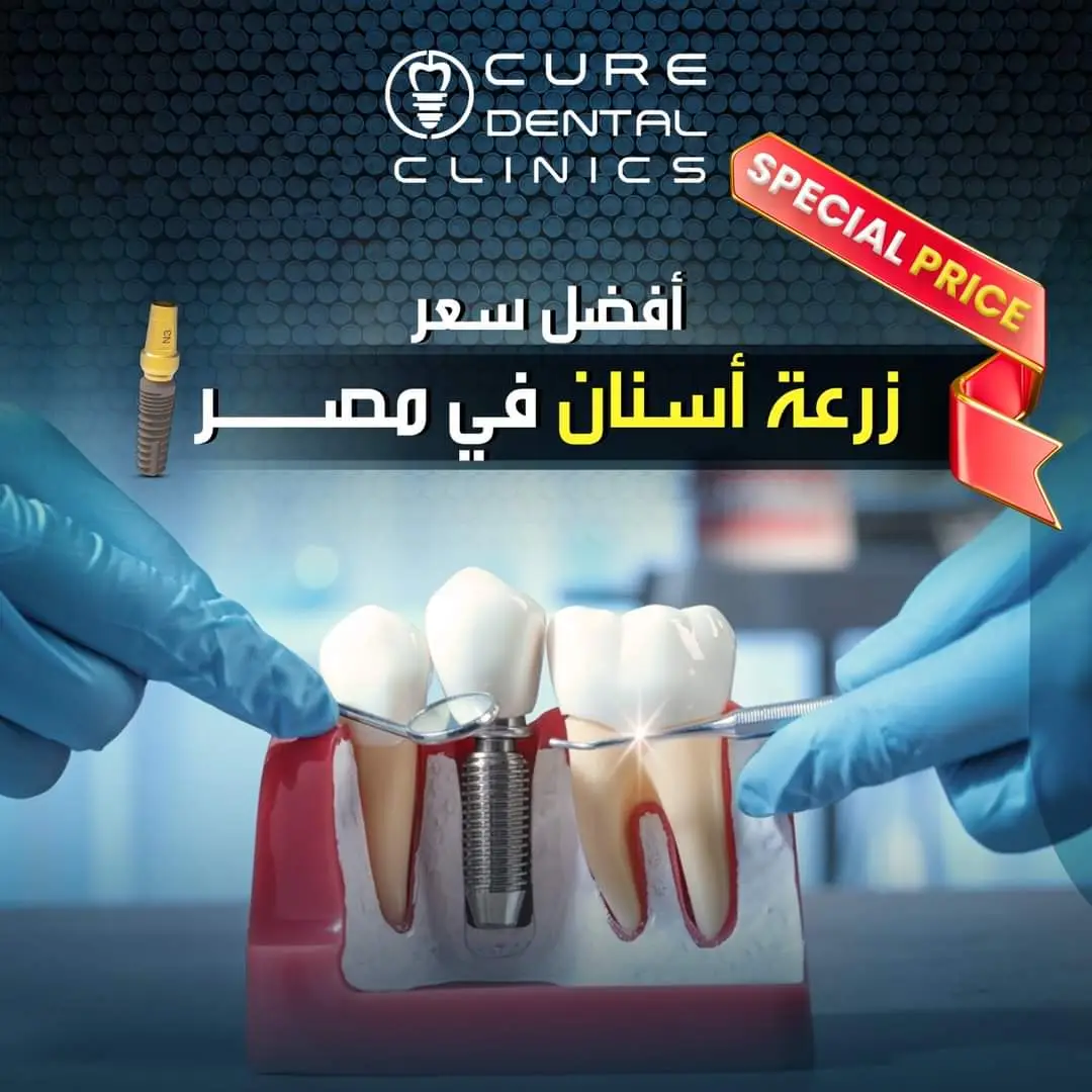 أفضل أسعار زراعة الأسنان في مصر