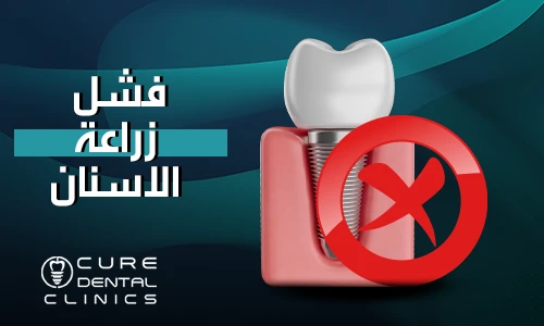 اسباب و اعراض فشل زراعة الاسنان و كيف تجنبتها