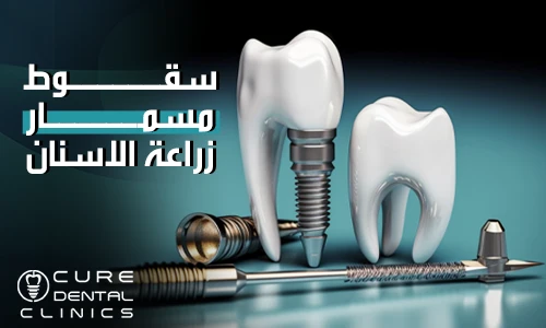 7 اسباب لسقوط مسمار زراعة الأسنان