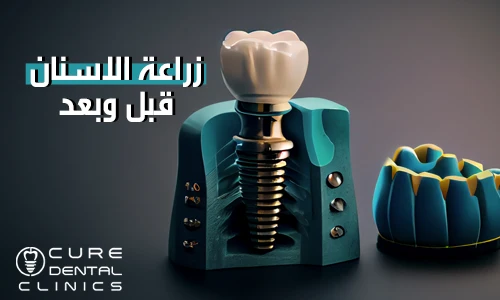 نتيجه اصعب حالة زراعة الاسنان قبل و بعد