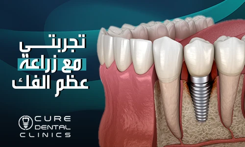 انبهرت من تجربتي مع زراعة عظم الفك الكامل