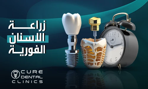 زراعة الأسنان الفورية بدون ألم و في ساعة واحده