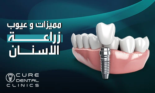 خفايا مميزات و عيوب زراعة الاسنان