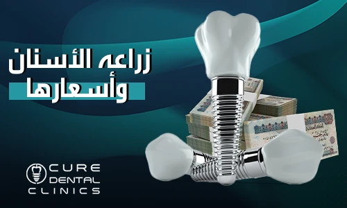أجود انواع زراعة الأسنان واسعارها