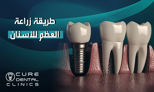 ما هي طريقة زراعة العظم للأسنان