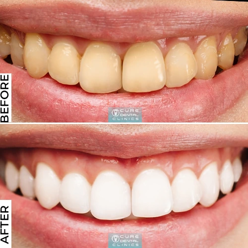 Dental Bleaching