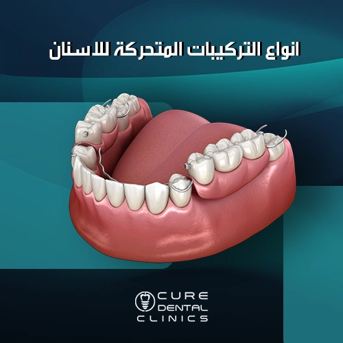 انواع التركيبات المتحركة للاسنان و بدائلها الأفضل