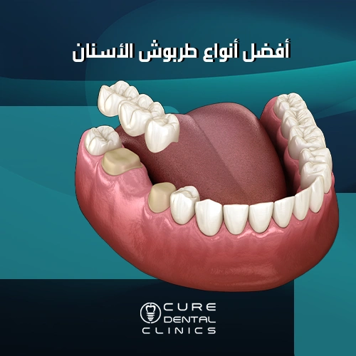 أفضل أنواع طربوش الأسنان