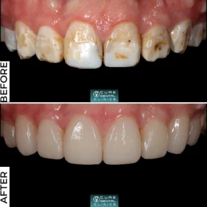 متى تحتاج لطربوش اسنان