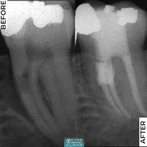 Root canal treatment علاج عصب الأسنان