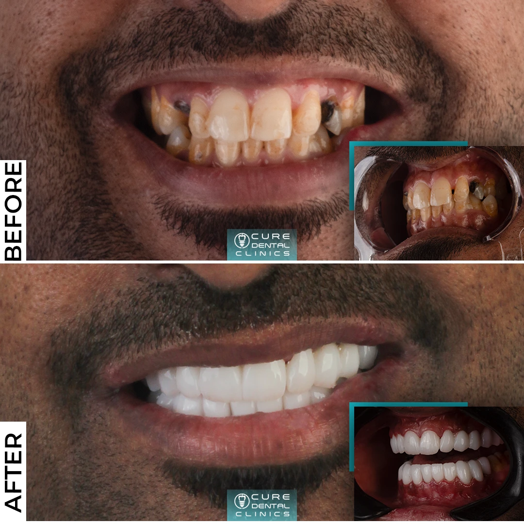 زراعة الاسنان قبل وبعد