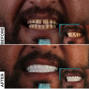 تجربتي مع ابتسامة هولييود