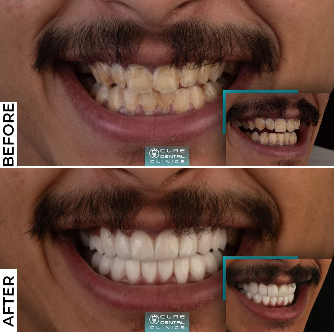 فينير الزيركون و البورسلين