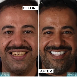 انواع التركيبات المتحركة للاسنان و بدائلها الأفضل