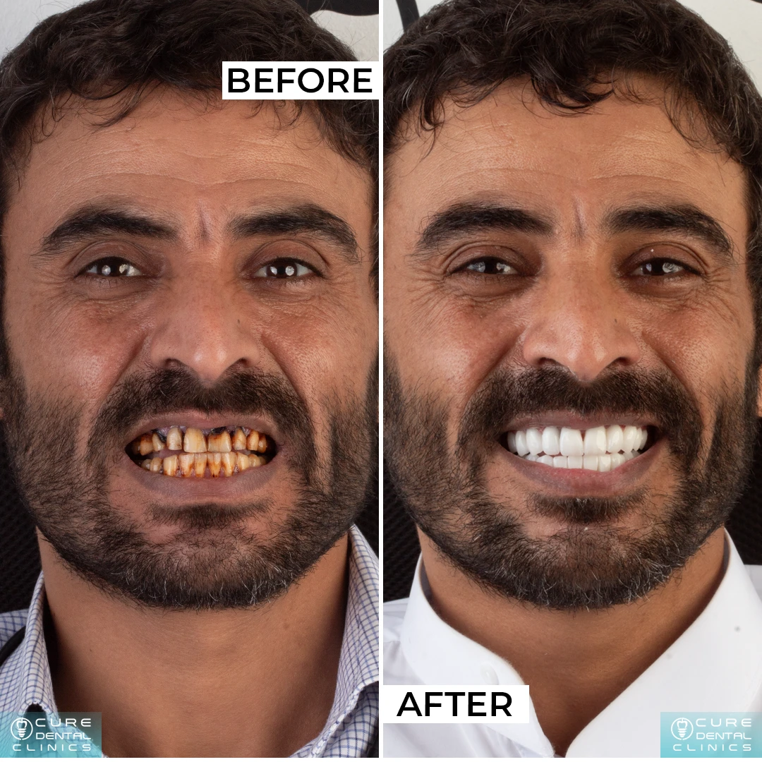 سعر فينير الأسنان