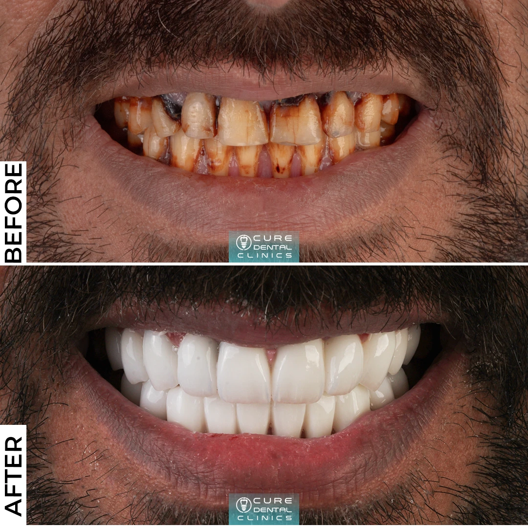 فينير الأسنان قبل وبعد