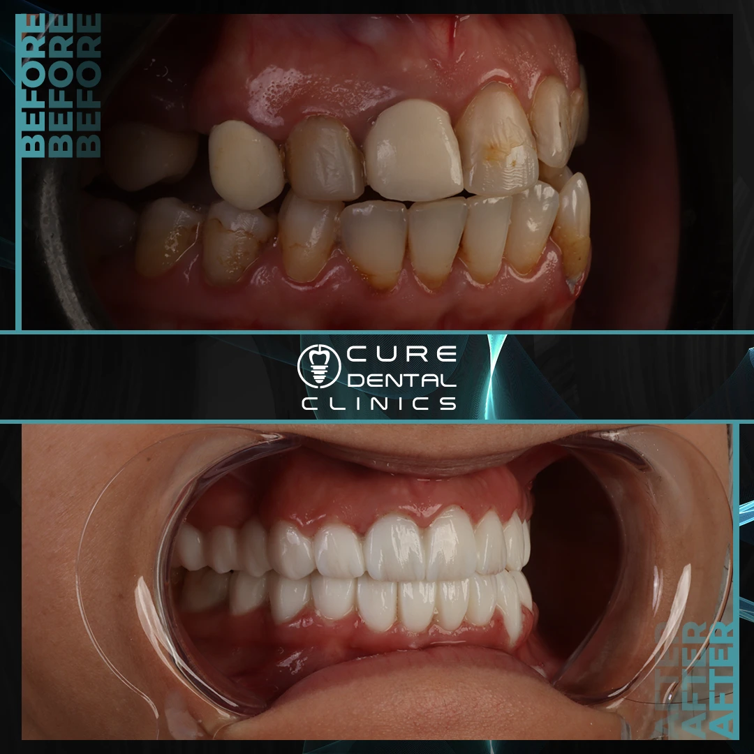 بدائل زراعة الاسنان