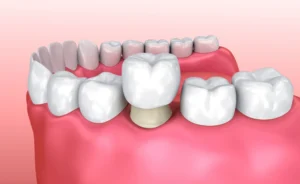 أفضل أنواع طربوش الأسنان