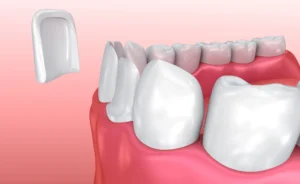 أنواع طربوش الأسنان واسعارها