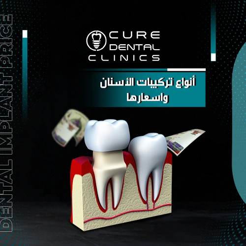 اجدد أنواع تركيبات الأسنان واسعارها 2024