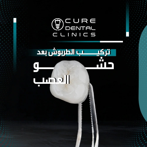 أهمية ومميزات تركيب الطربوش بعد حشو العصب