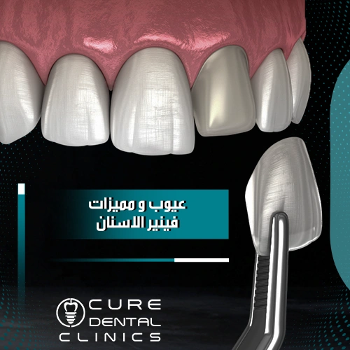 5 مميزات و عيوب فينير الاسنان غير متوقعه