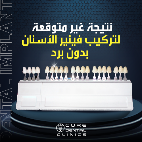 نتيجة فينير الأسنان بدون برد ناجحه 100%