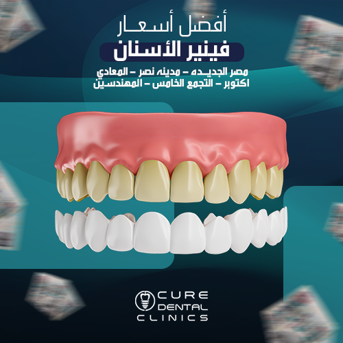 أشكال و اسعار فينير الاسنان في مصر الجديده 2024