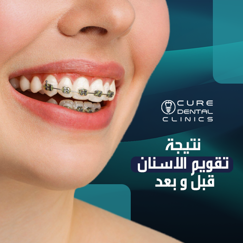 نتيجه تقويم الاسنان قبل و بعد