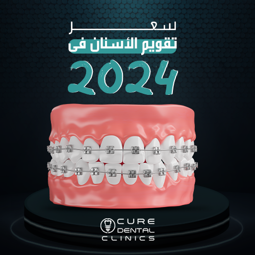 سعر تقويم الأسنان 2024 و اقصر مده للوصول لنتيجه