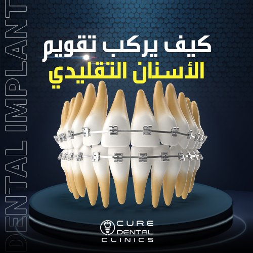 نتيجه ماذا يفعل التقويم في الاسنان