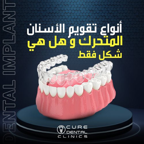 أفضل 4 انواع تقويم الاسنان المتحرك و نتائجهم