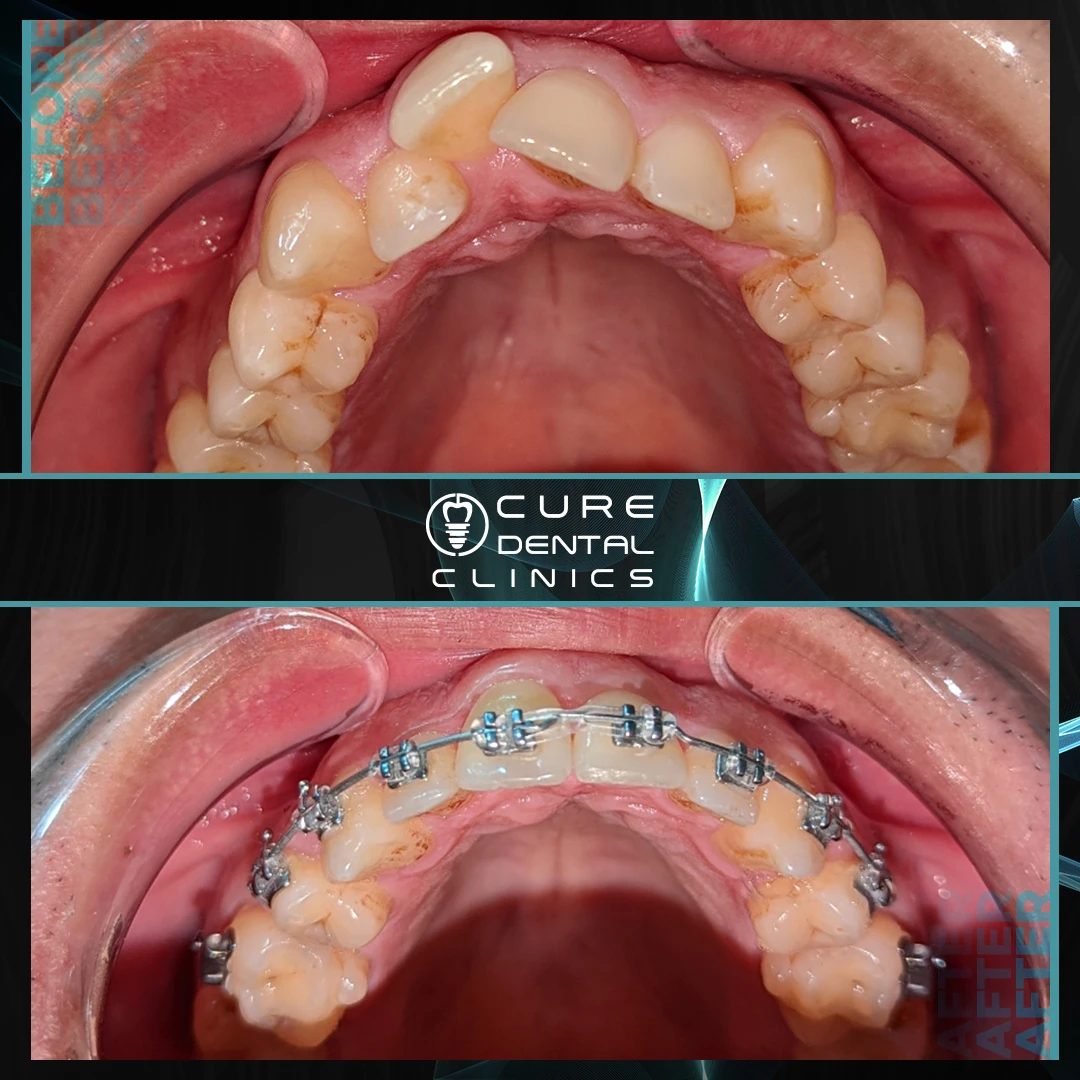تجربتي مع تقويم الأسنان