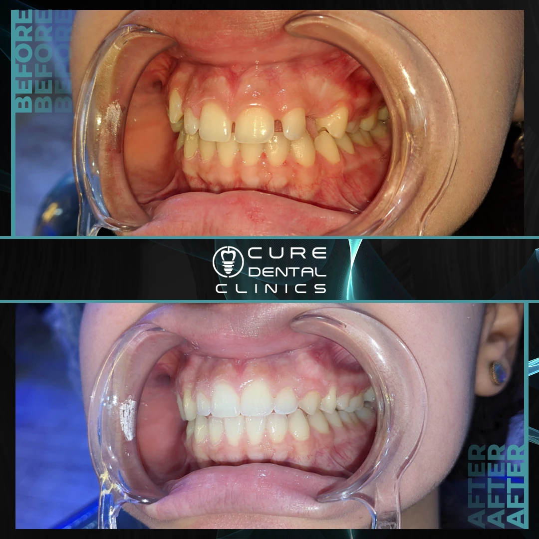 تقويم الأسنان