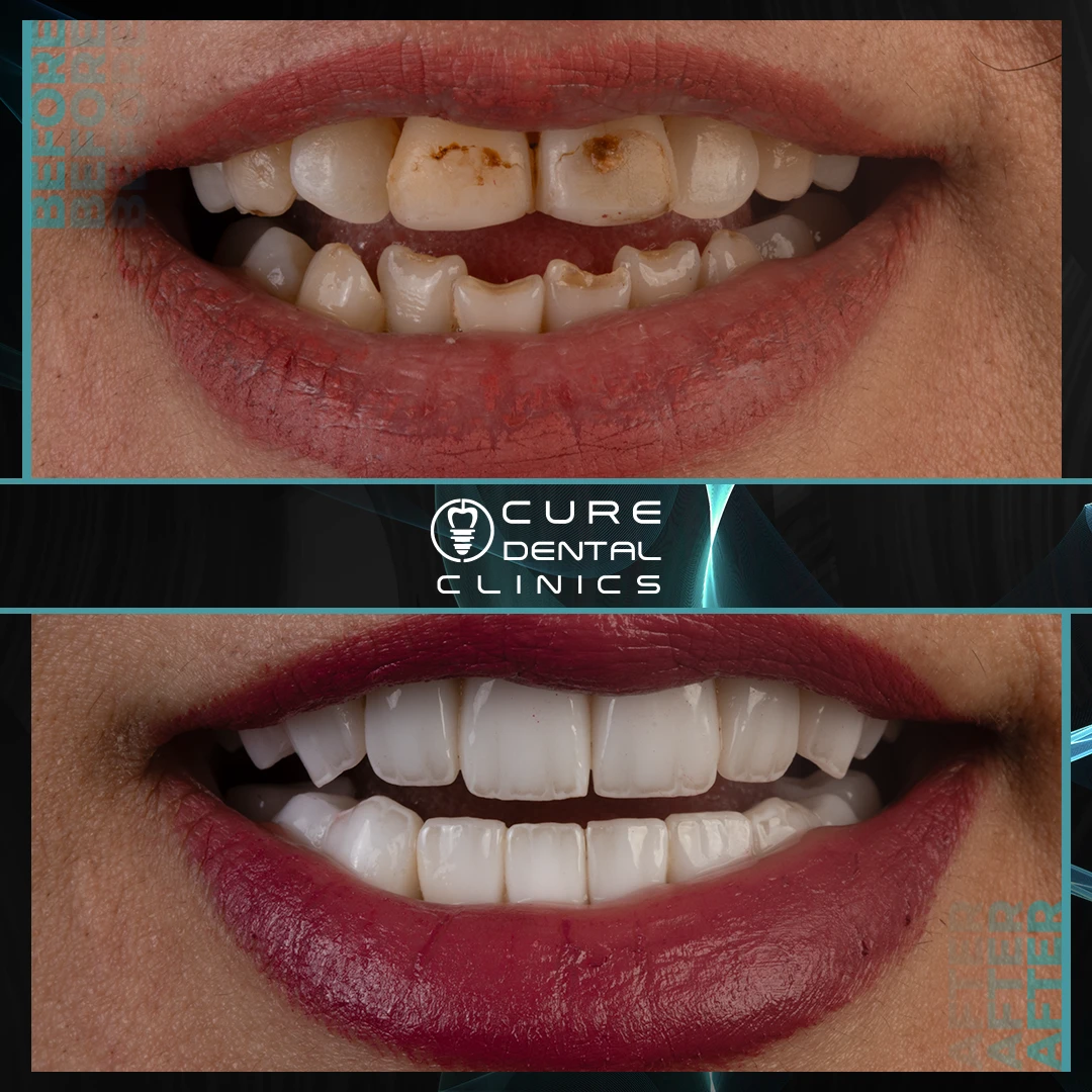 فينير الأسنان قبل و بعد