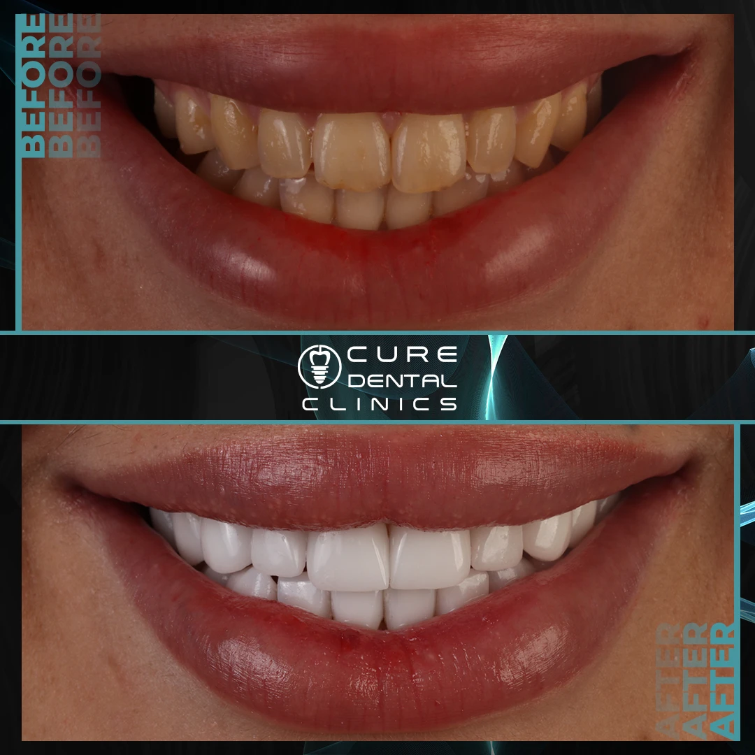 نتائج فينير الأسنان