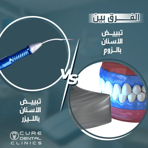 الفرق بين تبييض الاسنان بالزوم و الليزر