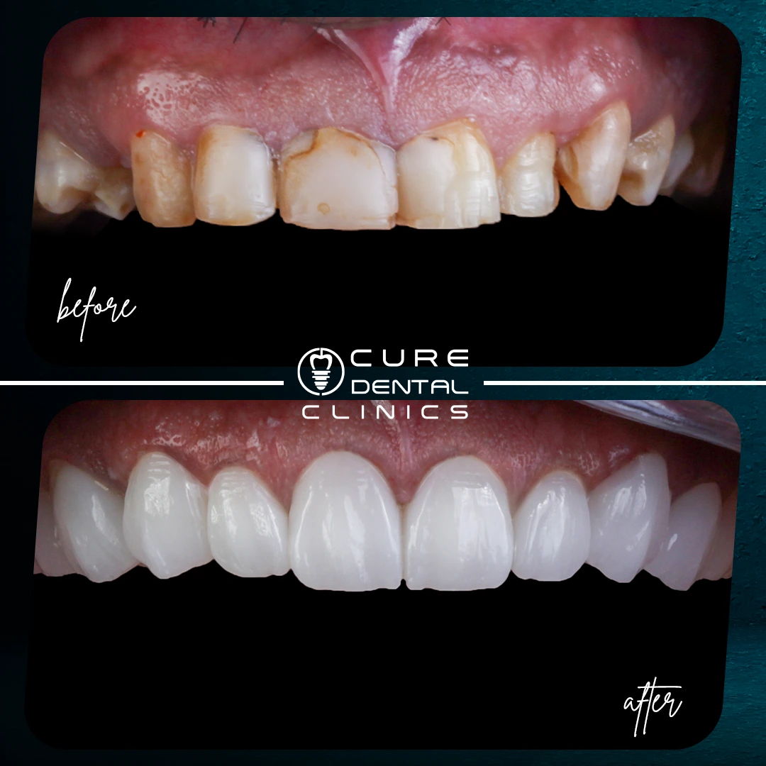 أبتسامه هوليود