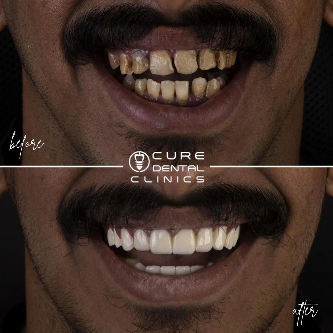 ابتسامه هولييود في كيور