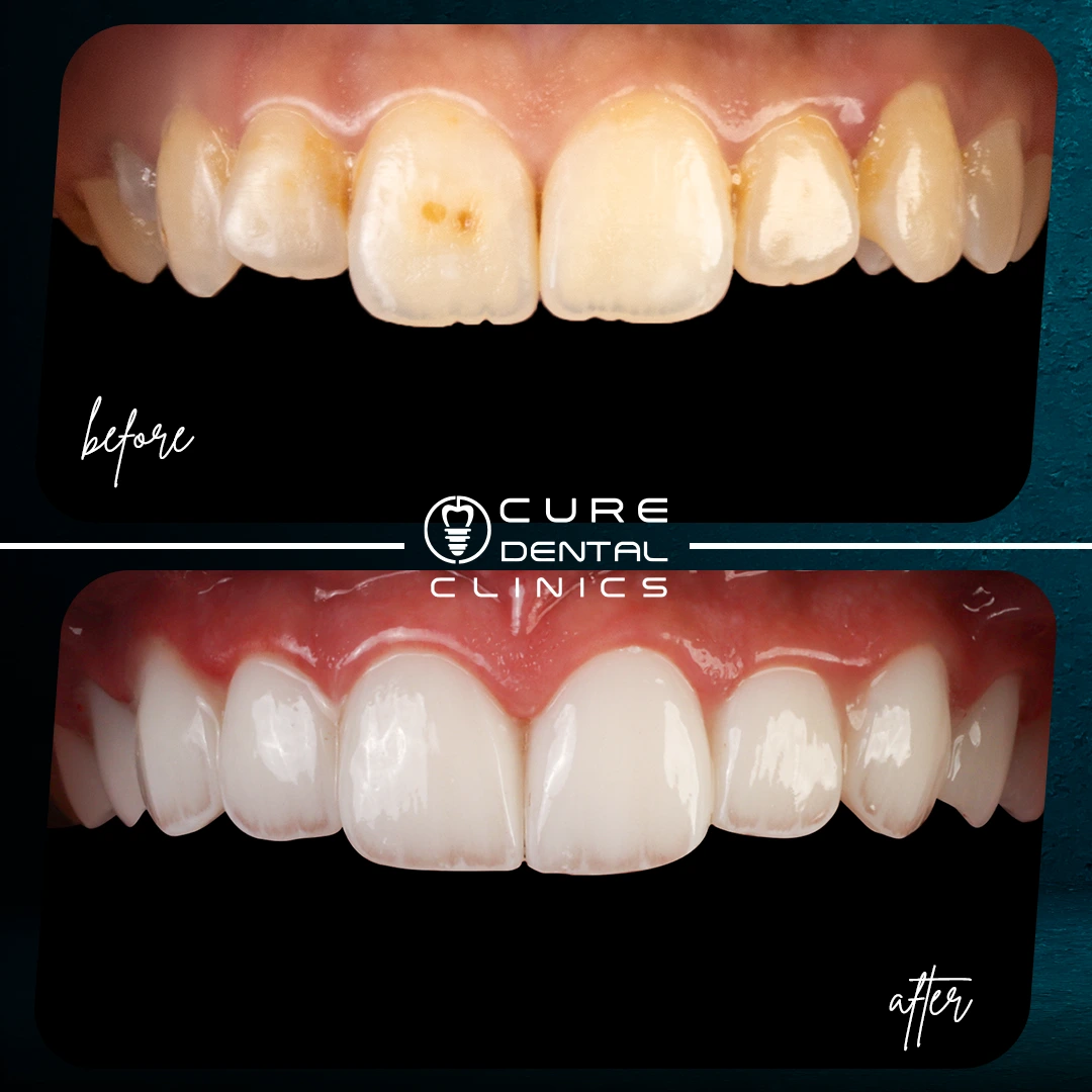 تبييض كيور جديد