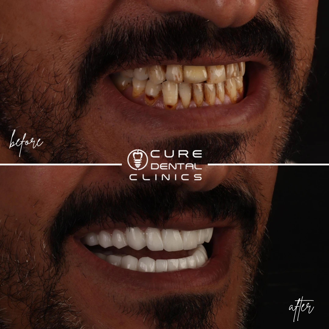 تبييض و فينير الأسنان