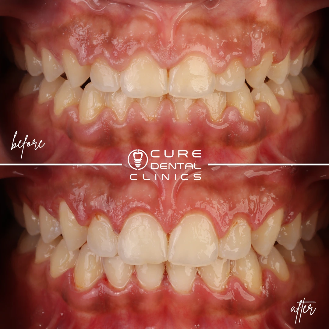 تنضيف أسنان