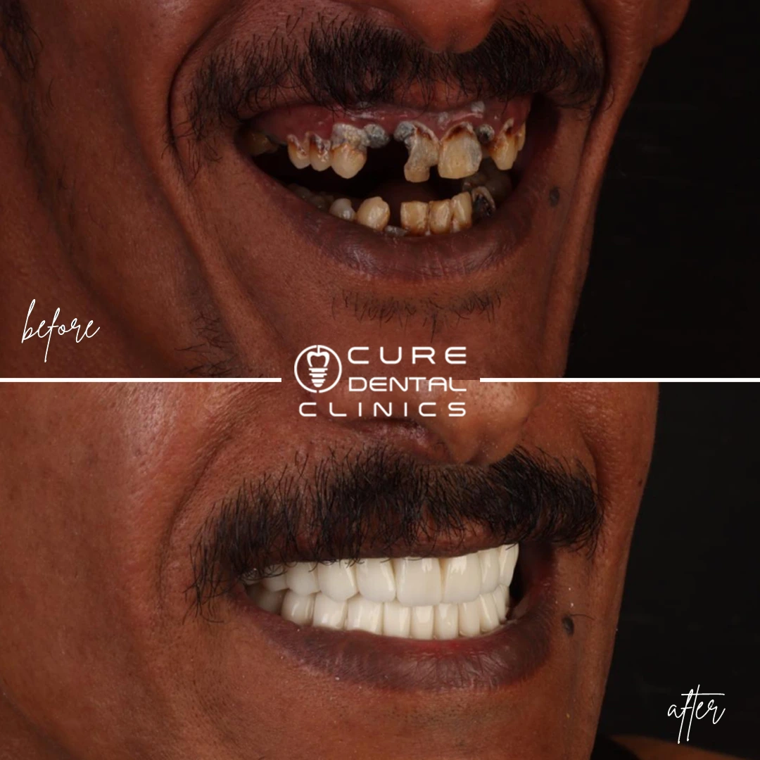 زراعة الأسنان الفوريه