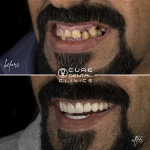 زراعة و تركيب الأسنان