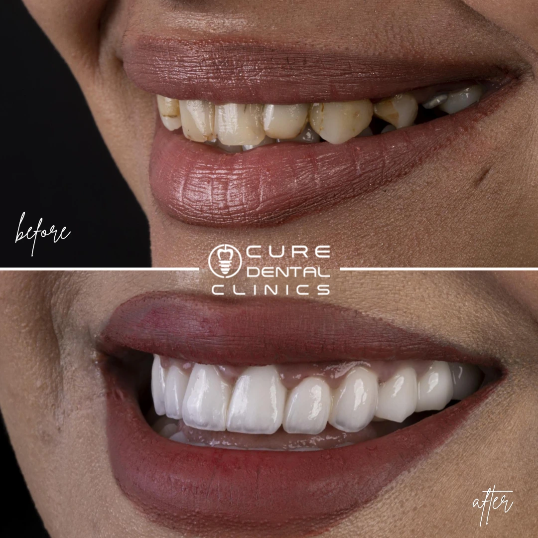 زراعة و فينير الأسنان