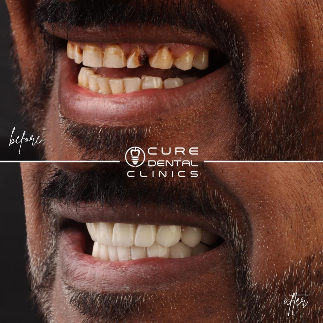 زراعه اسنان فوريه