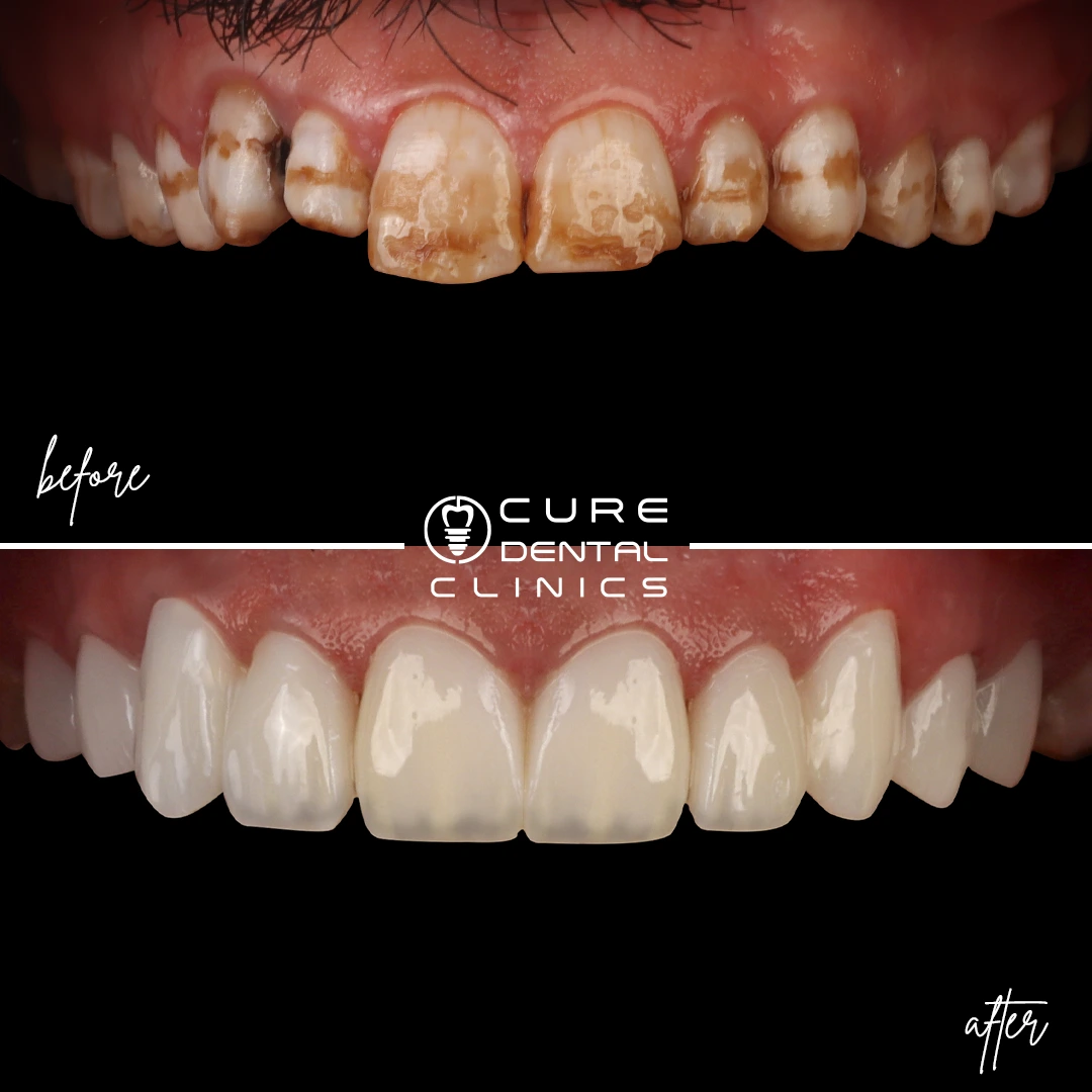 فينير اسنان جديد