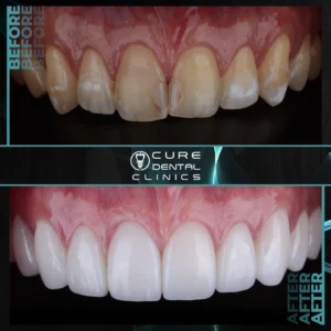 شكل الطربوش البورسلين